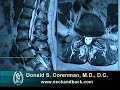 How to Read a MRI of Lumbar Degenerative Spondylolisthesis and Spinal Stenosis