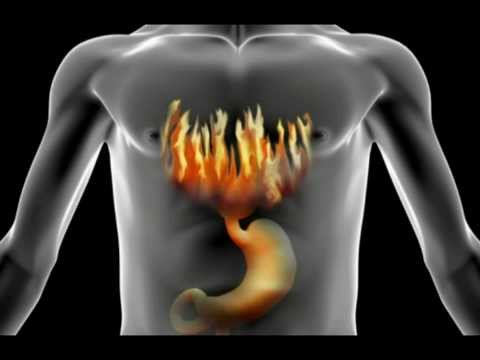 how to eliminate acid reflux