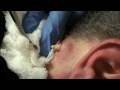 Justin's junk cyst on neck
