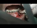 Lower anterior orthodontic anchor placement, part 3, force activation
