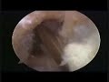 Knee op in 9mins.wmv