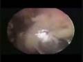 videos de Knee op in 9mins.wmv