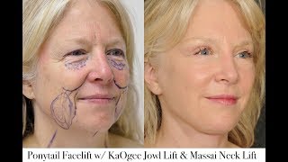 Ponytail Facelift Before And After Video - The Future of Plastic Surgery