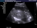 abscesso pos aborto