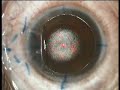 LASIK Eye Surgery LASIK Eye Surgery