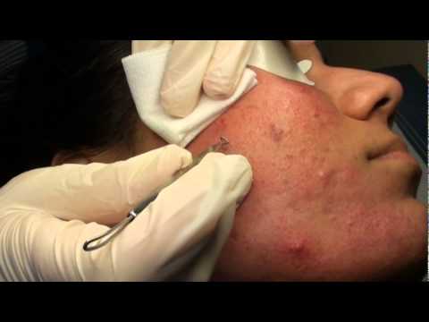 how to unclog pores without squeezing