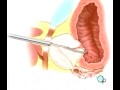PreOp® Patient Education TURP Transurethral Resection Prosta