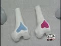Gender Specific Knee Replacement - Special TKR for Women