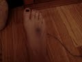 Foot Injuries