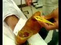 Foot Ulcer Foot Ulcer