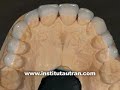 Est�tica dental: coronas antiguas (problema y soluci�n)