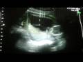 14 week 4 day ultrasound with 3D/4D