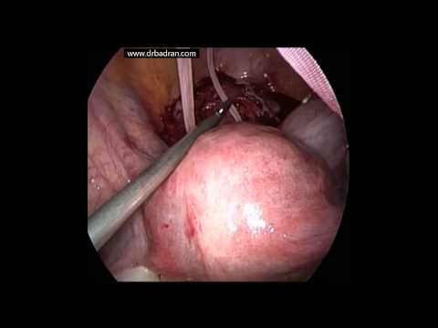 how to perform cervical cerclage