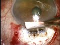 Non Penetrating Deep Sclerectomy with CO2 LASER