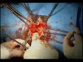 Anterior and Posterior Vaginal Repair Plus IVS Tunner
