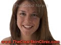 Acne Vulgaris Treatment