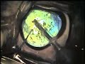 Dog Cataract - Phacoemulsifcation