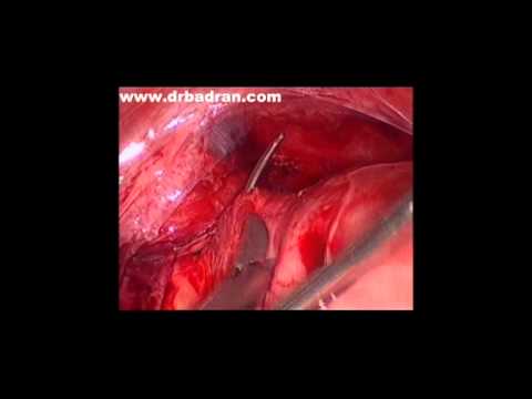 how to perform cervical cerclage