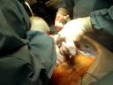 C-section Scarlet being taken out