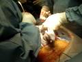 C-section Scarlet being taken out