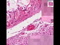 Histopathology Heart, pericardium--Metastatic breast carcinoma