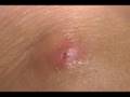 Bot Fly Larvae Hosting Fred Part II High Quality Video