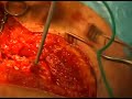 removing-the-tumour.html