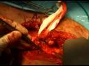 Removing the tumour