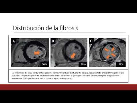 Cicatriz ventricular izquierda y pronóstico de la miocardiopatía chagásica crónica. Dra. María Eugenia Doppler. Residencia de Cardiología. Hospital C. Argerich. Buenos Aires