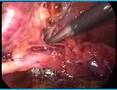 laparoscopic chlelecystectomy for cholecystitis