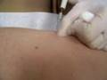 Dermatology: Mole Removal