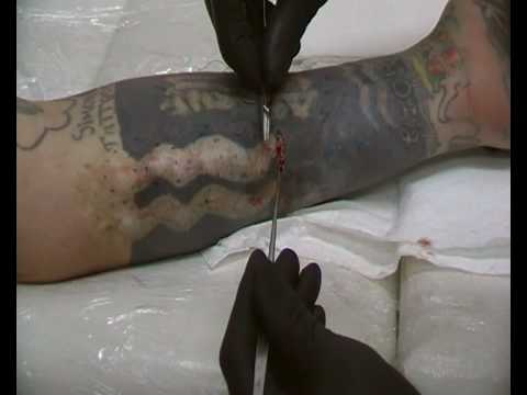 si ody mod implants 2 scarring body mod. si ody mod implants 2