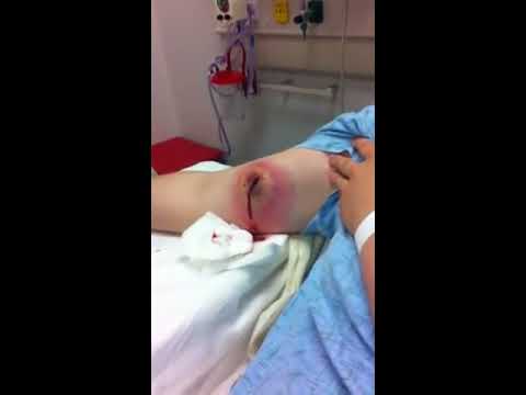 how to drain your own abscess