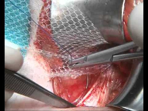 hernioplastia - http://sedici.unlp.edu.ar/handle/10915/30064 Video en el que se relata una operación de hernia inguinal con técnica de Lichtenstein. En esta primera parte, s...