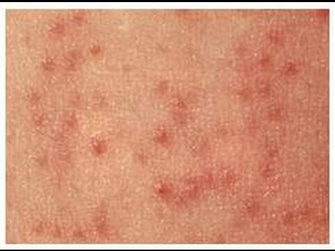how to remove kp bumps