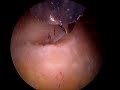 Arthroscopic Rotator Cuff Repair - Small Supraspinatus Tear Arthroscopic Rotator Cuff Repair - Small Supraspinatus Tear