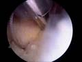 Arthroscopic Rotator Cuff Repair - Small Supraspinatus Tear