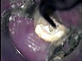 Furcation Perforation repair