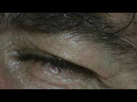 how to administer xalatan eye drops