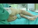 Sciatic Nerve Block, Posterior Classic Approach.?????? Sciatic Nerve Block, Posterior Classic Approach.??????