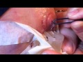 Monsters Inside Me - Botfly Removal, by Paul Rosolie