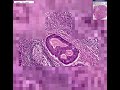Histopathology Lymph node -- Adenocarcinoma, metastatic to l