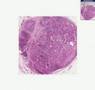 Histopathology Lymph node -- Adenocarcinoma, metastatic to l