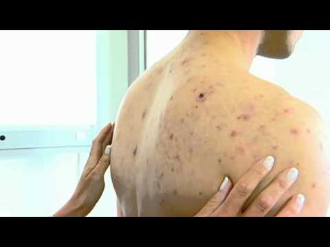 Acne Back NYC -  (212) 644-6454 - NYC Cystic Acne Back - New York, NY
