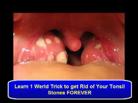 how to treat tonsil stones