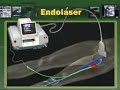 Endolaser - endol�ser