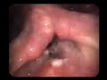 papilloma