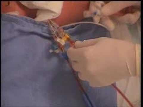 Concurrent CRRT and plasmapheresis
