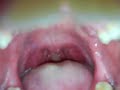 Sore Throat