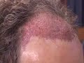 HAIR TRANSPLANT DALLAS: GRAFT PLACEMENT VIDEO 3 HAIR LOSS HAIR TRANSPLANT DALLAS: GRAFT PLACEMENT VIDEO 3 HAIR LOSS
